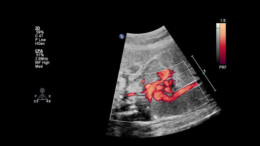 דוגמה לאקו לב עובר ( תמונה למאמר)